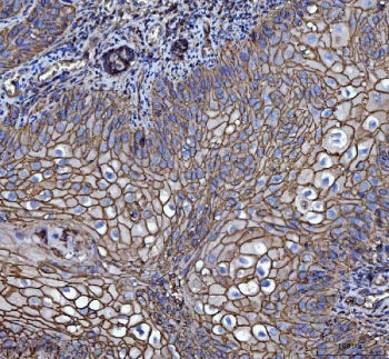 IHC staining of FFPE human laryngeal squamous cell carcinoma tissue with Emmprin antibody. HIER: boi