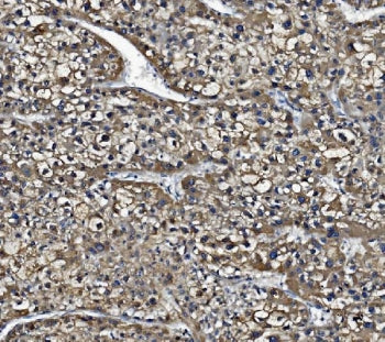 IHC staining of FFPE human liver cancer with CES1 antibody. HIER: boil tissue sections in pH8 EDTA f