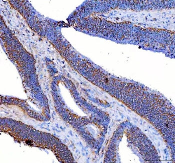 IHC staining of FFPE human colon cancer tissue with RSPH3 antibody. HIER: boil tissue sections in pH