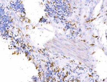 IHC staining of FFPE human gastric cancer tissue with Endophilin A1 antibody. HIER: boil tissue sect