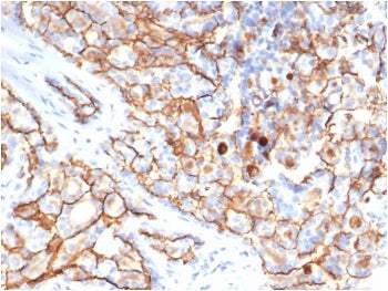 IHC staining of FFPE human papillary renal cell carcinoma tissue with CD133 antibody (clone PROM/631