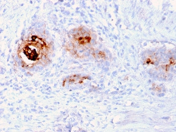 IHC staining of human breast carcinoma with recombinant TAG-72 antibody (clone rB72.3). HIER: boil t