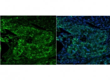 Immunofluorescent staining of FFPE human breast cancer with MCM5 antibody (green) and DAPI nuclear s