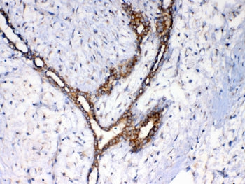 IHC testing of FFPE human breast cancer tissue with NSF antibody at 1ug/ml. Required HIER: steam sec