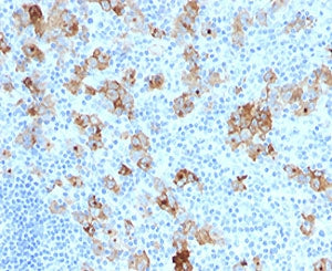 IHC testing of formalin-fixed, paraffin-embedded human Hodgkin's lymphoma stained with CD30 antibody