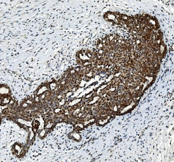 IHC staining of FFPE human breast cancer tissue with FGF2 antibody. HIER: boil tissue sections in pH