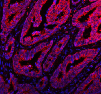 Immunofluorescent staining of FFPE human colon cancer tissue with ARHGEF7 antibody (red) and DAPI nu