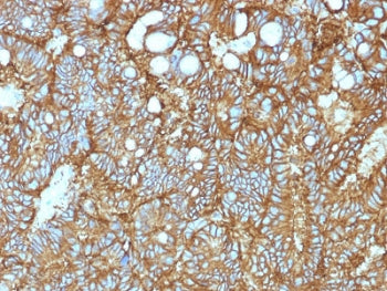IHC testing of FFPE human hepatocellular carcinoma and anti-EpCAM antibody (clone EGP40/1372). Requi