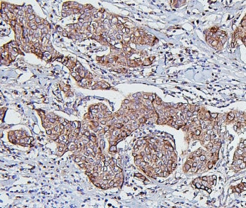IHC staining of FFPE human breast cancer with Hsp60 antibody. HIER: boil tissue sections in pH6, 10m