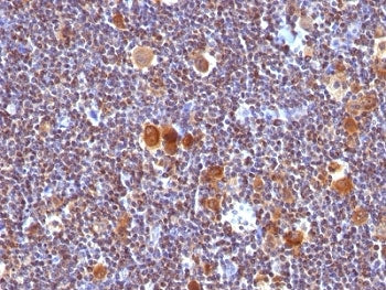 IHC analysis of formalin-fixed, paraffin-embedded human Hodgkin's lymphoma stained with anti-Bax ant