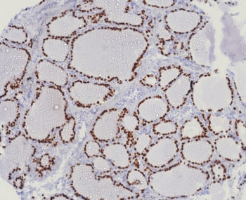 IHC staining of FFPE human lung adenocarcinoma tissue with NKX2.1 antibody (clone TTF1/8123R). HIER: