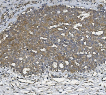 IHC staining of FFPE human breast cancer with ULBP1 antibody. HIER: boil tissue sections in pH8 EDTA