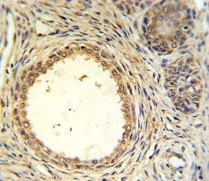 AMH antibody IHC analysis in formalin fixed and paraffin embedded prostate carcinoma.