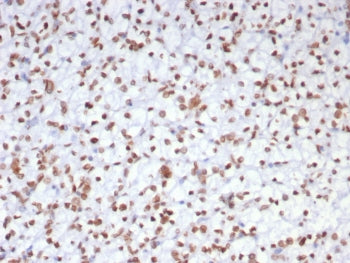 IHC staining of FFPE human renal cell carcinoma tissue with EZH2 antibody (clone EZH2/7507). HIER: b