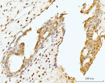 IHC staining of FFPE human breast cancer tissue with Nucleostemin antibody. HIER: boil tissue sectio