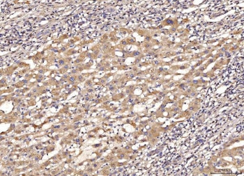 IHC staining of FFPE human liver cancer tissue with MYD88 antibody. HIER: boil tissue sections in pH