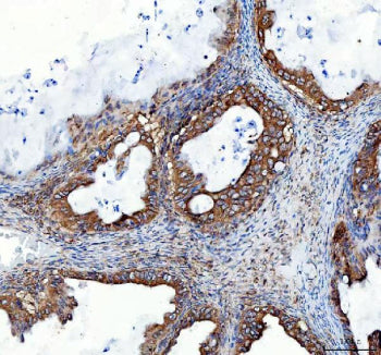 IHC staining of FFPE human ovarian serous adenocarcinoma tissue with Heme Oxygenase 2 antibody. HIER