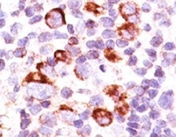 IHC: Formalin-fixed, paraffin-embedded human Hodgkin's lymphoma stained with anti-Bcl-X antibody (SP