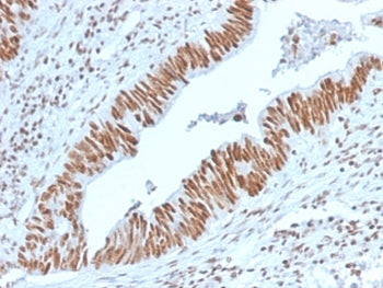 IHC staining of FFPE human colon carcinoma with Nucleophosmin antibody (clone NPM1/3398). HIER: boil