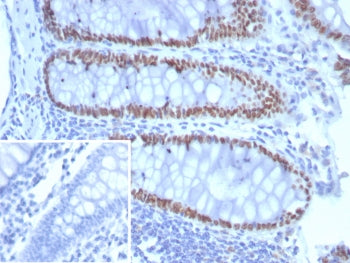 IHC staining of FFPE human colon carcinoma tissue with SATB2 antibody (clone SATB2/8292R). Inset: PB
