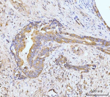 IHC staining of FFPE human gall bladder adenosquamous carcinoma tissue with HPK1 antibody. HIER: boi