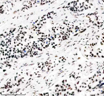 IHC staining of FFPE human lung cancer tissue with PABPN1 antibody, HRP-secondary and DAB substrate.