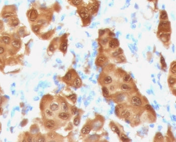 IHC testing of FFPE human melanoma tissue with recombinant S100B antibody (clone PS1B1-2R). HIER: st