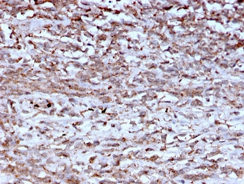 IHC staining of FFPE human hepatocellular carcinoma with Cathepsin K antibody (clone CTSK/2793). HIE