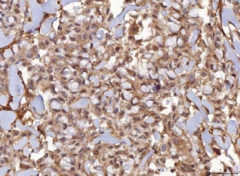 IHC staining of FFPE human breast infiltrating ductal carcinoma tissue with AHSA1 antibody. HIER: bo