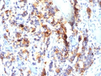 IHC: Formalin-fixed, paraffin-embedded human gastric carcinoma stained with Mucin-5AC antibody (SPM2