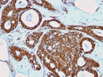 IHC testing of FFPE human breast cancer with recombinant beta Catenin antibody (clone rCTNNB1/2173).