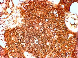 IHC staining of HER+ FFPE human breast cancer with HER2 antibody at 4ug/ml. HIER: Steamed with pH6 c