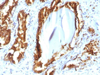 IHC testing of human prostate carcinoma with recombinant PSAP antibody (clone rACPP/1338). Required 
