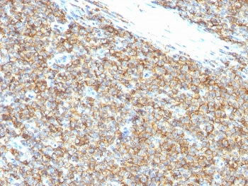 IHC staining of FFPE Ewings sarcoma tissue with CD99 antibody (clone 12E7). HIER: boil tissue sectio