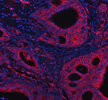 Immunofluorescent staining of FFPE human A549 cells with PPM1F antibody (red) and Beta Tubulin mAb (