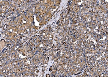 IHC staining of FFPE human thyroid papillary carcinoma tissue with MLXIP antibody. HIER: boil tissue