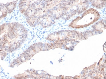 IHC staining of FFPE human prostate carcinoma with AKR1C2 antibody (clone CPTC-AKR1C2-1). HIER: boil