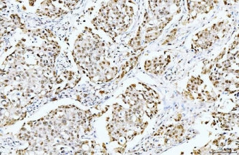 IHC staining of FFPE human breast cancer tissue with Cyclophilin E antibody. HIER: boil tissue secti