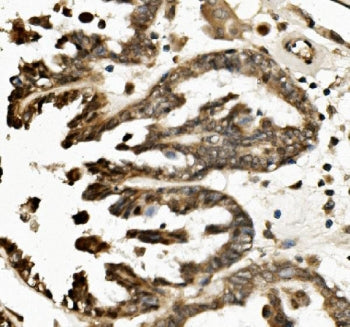 IHC staining of FFPE human ovarian cancer with TXNIP antibody. HIER: boil tissue sections in pH8 EDT
