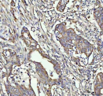 IHC staining of FFPE human rectum adenocarcinoma tissue with G-CSF antibody. HIER: boil tissue secti
