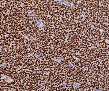 FFPE human ovarian adult granulosa cell tumor with recombinant FOXL2 antibody (clone FOXL2/7989R). H