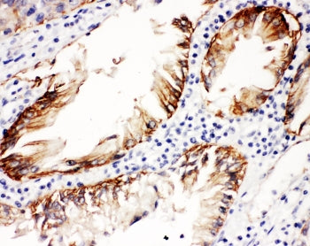IHC staining of FFPE human intestinal cancer with ITGB4 antibody at 1ug/ml. HIER: boil tissue sectio