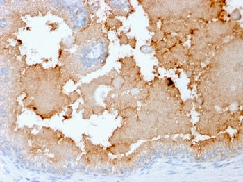 IHC staining of FFPE human prostate carcinoma with recombinant AKT1 antibody (clone rAKT1/2491). HIE