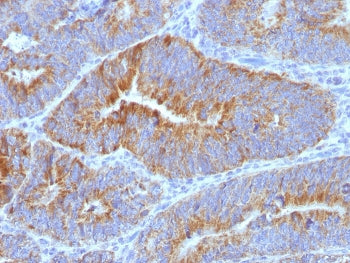 IHC: FFPE human colon carcinoma stained with CD176 antibody (clone SPM320) at 4ug/ml.