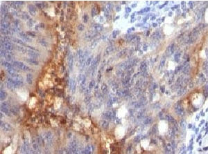 IHC testing of FFPE human colon carcinoma and Secretory Component Glycoprotein antibody (clone SRGP8