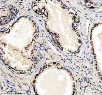 Immunohistochemical staining of UBE2F using anti-UBE2F antibody. UBE2F was detected in a paraffin-em