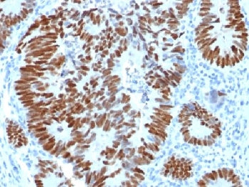 IHC testing of FFPE human colon carcinoma with p53 antibody. Required HIER: boil tissue sections in 