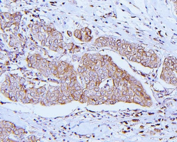 IHC staining of FFPE human breast cancer with ApoER2 antibody. HIER: boil tissue sections in pH8 EDT