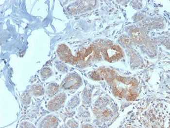 IHC staining of FFPE human breast carcinoma with recombinant MVP antibody (clone VP2897R). HIER: boi