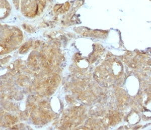 IHC staining of FFPE human breast carcinoma with recombinant MVP antibody (clone MJVP-1R). HIER: boi